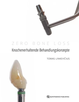 Abbildung von Linkevicius | Zero Bone Loss: Knochenerhaltende Behandlungskonzepte | 1. Auflage | 2020 | beck-shop.de