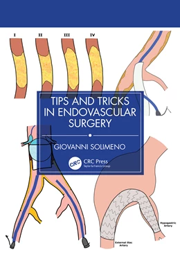 Abbildung von Solimeno | Tips and Tricks in Endovascular Surgery | 1. Auflage | 2025 | beck-shop.de